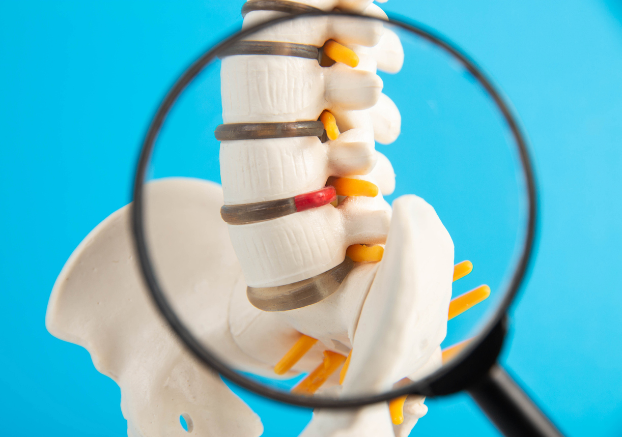 Close-up of lumbar spine model under magnifying glass, showing intervertebral hernia