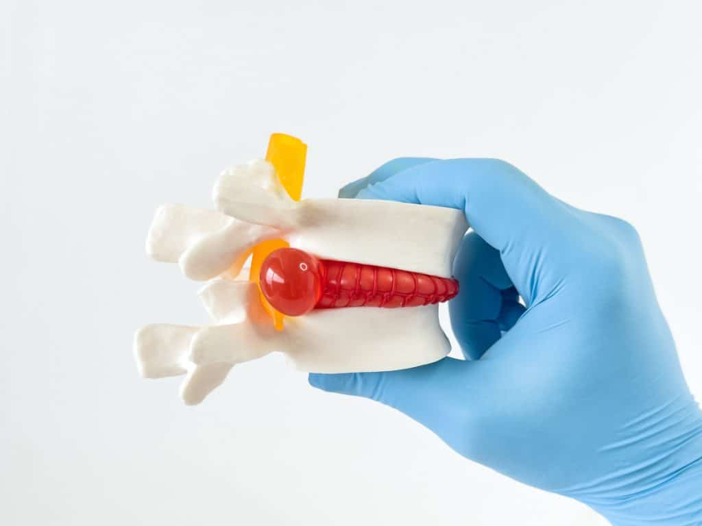 Herniated Cervical Disc Treatment In Nj Nu Spine