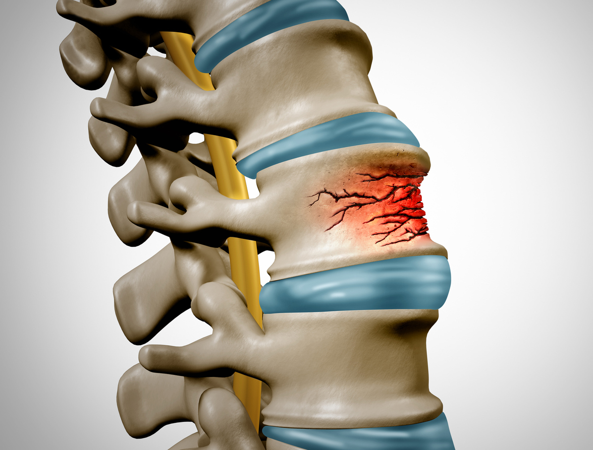 Medical concept art of spine with stress fractures