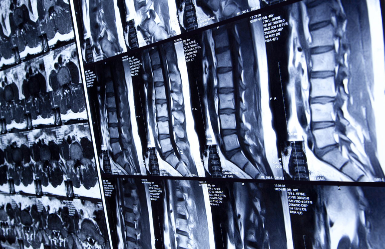 Multiple MRI scans of human spine 