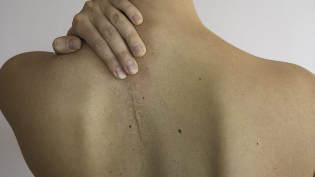Upper back with surgery scar