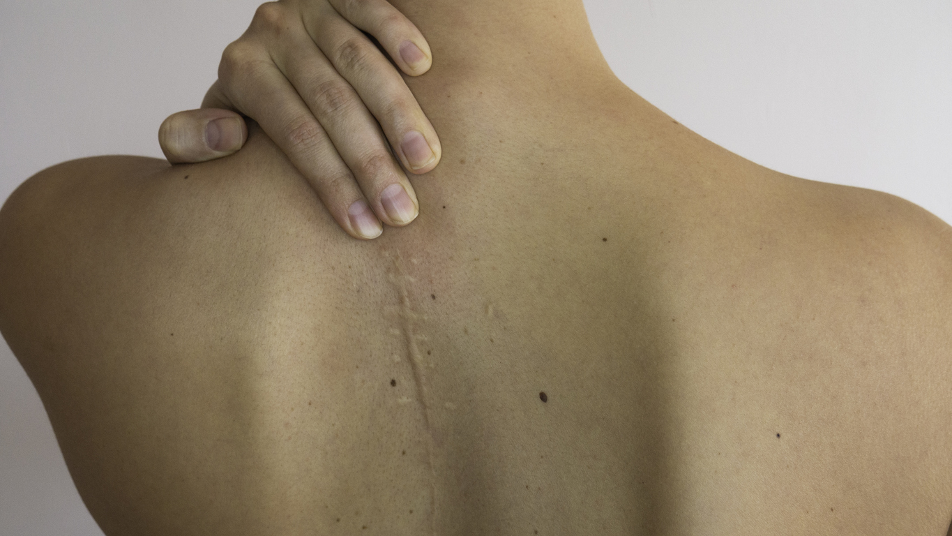 Upper back with surgery scar