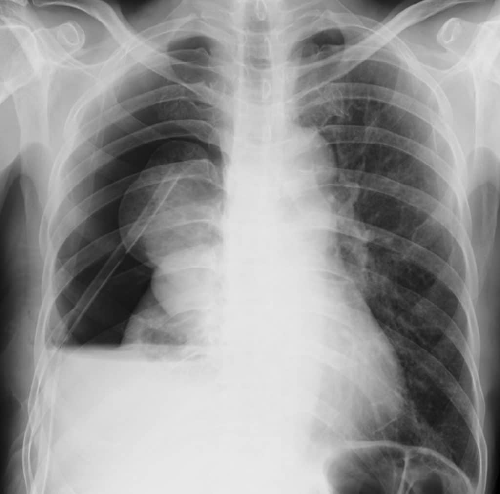 X-ray image showing spine curved by scoliosis