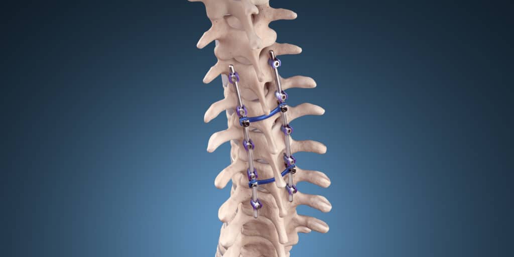 3D illustration of thoracic spine with rods and pedicle screws