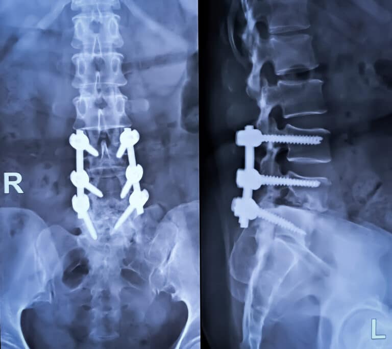 X-ray image of spine with fusion implants
