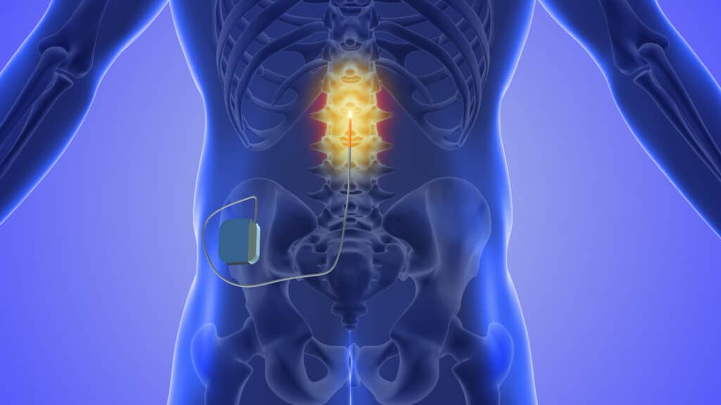 Concept art of spinal cord stimulator implant