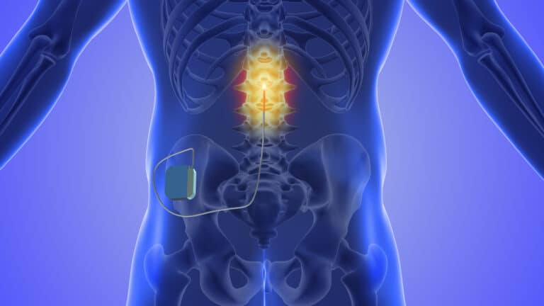Concept art of spinal cord stimulator implant