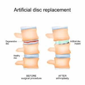 Comparison graphic of spine before and after disc replacement