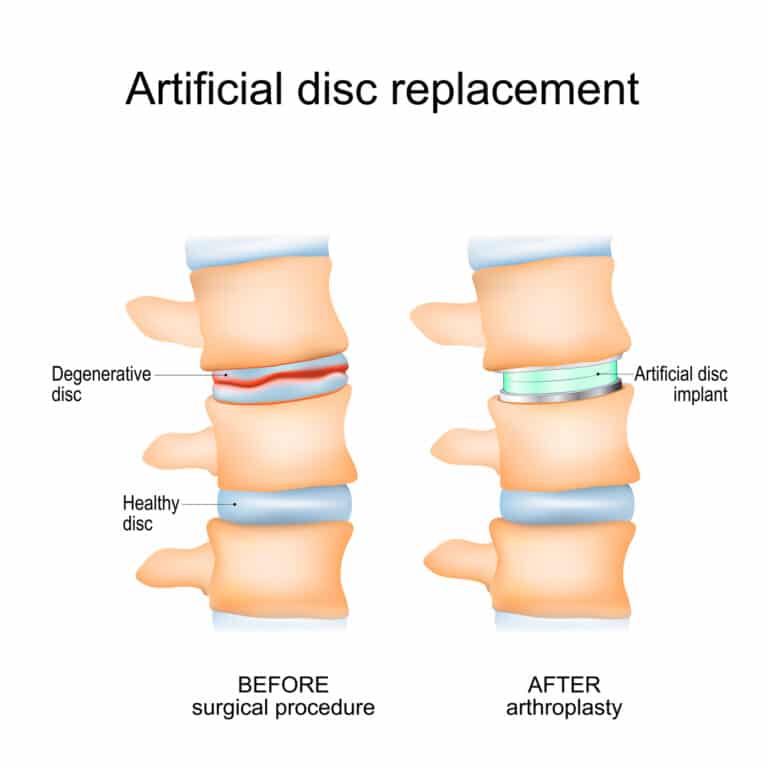 Comparison graphic of spine before and after disc replacement