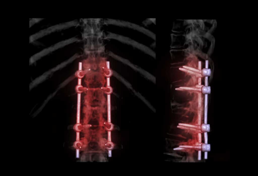 Medical imaging of spine with screw and rod implants