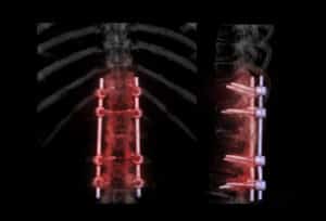 Medical imaging of spine with screw and rod implants