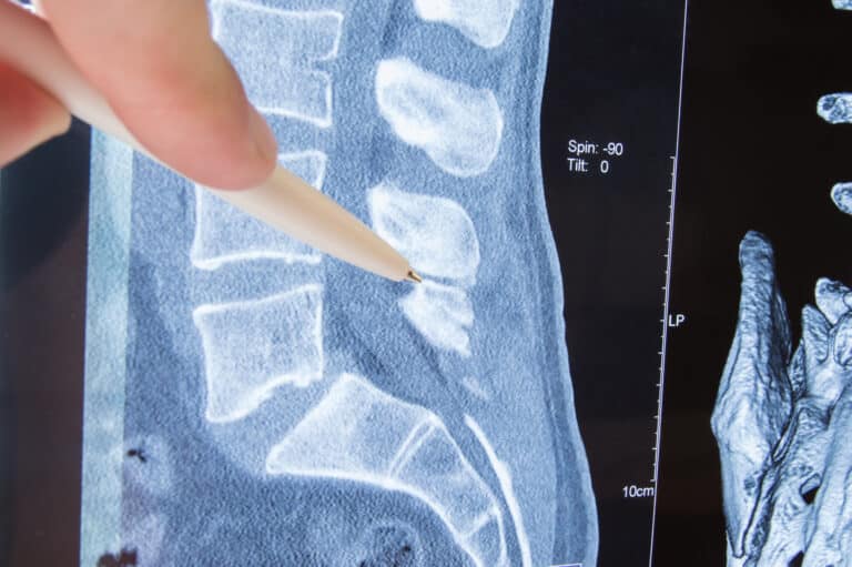 Radiologist pointing at MRI image of lumbar spine
