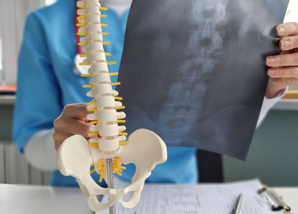 Doctor holding up model of spine and patient X-ray scan