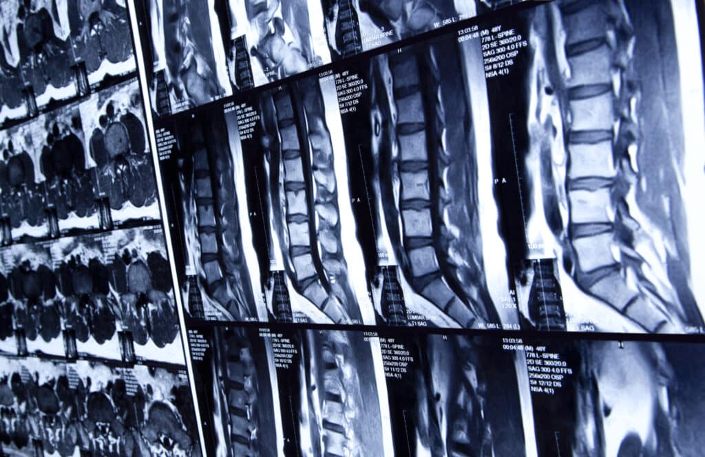 Multiple spinal X-rays mounted onto wall