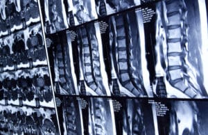 Multiple spinal X-rays mounted onto wall