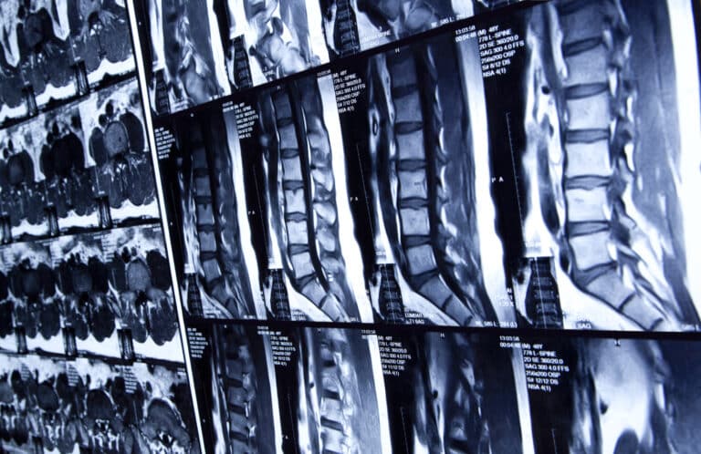 Multiple spinal X-rays mounted onto wall