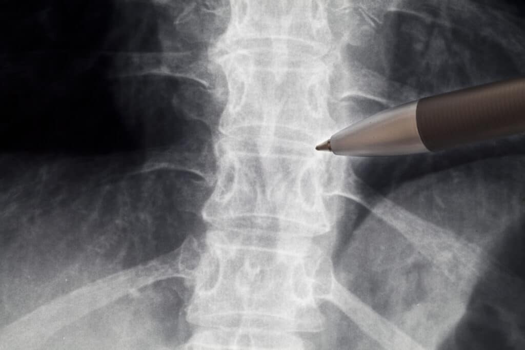Close image of pen pointing at spine radiography