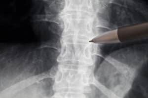 Close image of pen pointing at spine radiography