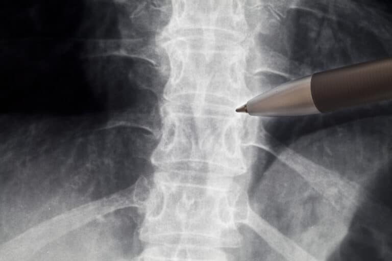 Close image of pen pointing at spine radiography