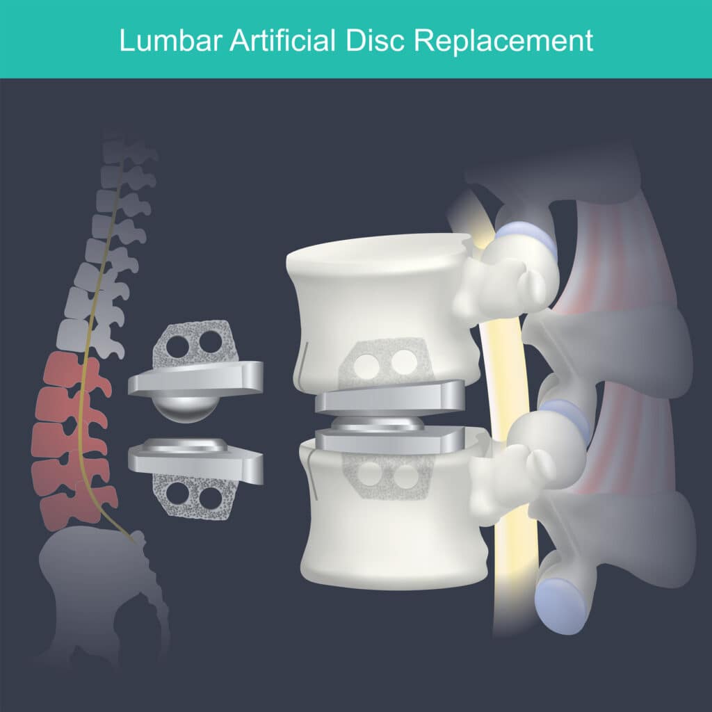 Illustration of lumbar artificial disc implant