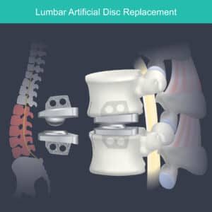 Illustration of lumbar artificial disc implant