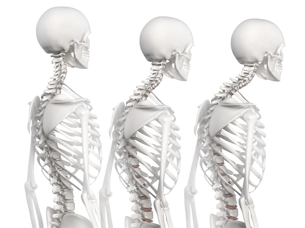 Medical illustration of kyphosis skeleton in three stages