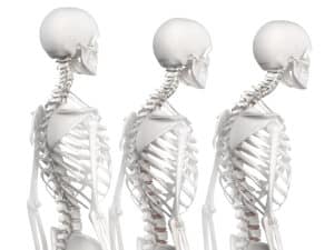 Medical illustration of kyphosis skeleton in three stages