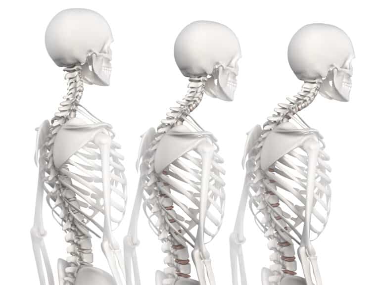 Medical illustration of kyphosis skeleton in three stages
