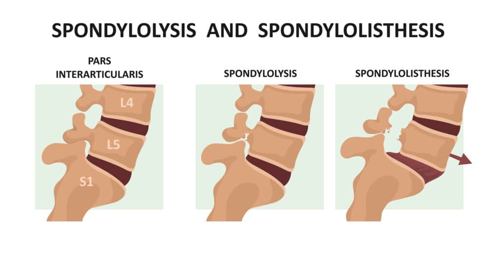 Medical illustration of spondylolysis and spondylolisthesis