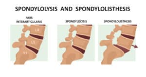 Medical illustration of spondylolysis and spondylolisthesis